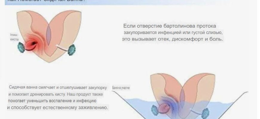 лечение бартолиновой кисты без операции