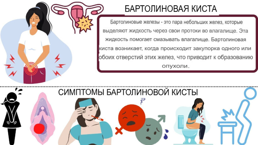 лечение бартолиновой кисты без операции
